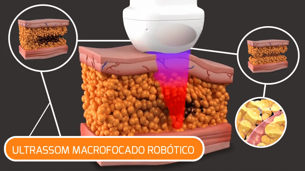 Ultrassom Macrofocado Robótico