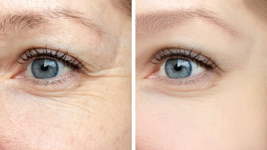 comparação de duas mulheres. a primeira é mais velha com menor produção de colágeno, já a segunda uma moça nova com maior produção da proteína.