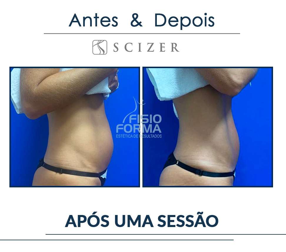 scizer antes e depois