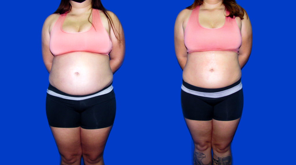 Resultado Emagrecimento e Gordura Localizada Abdomem