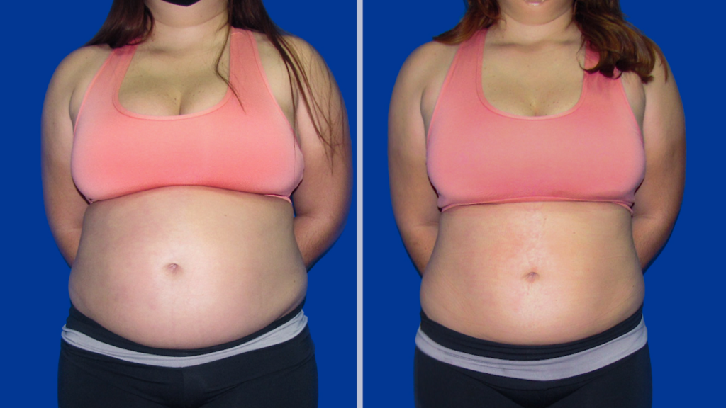Resultado Emagrecimento e Gordura Localizada Abdomem