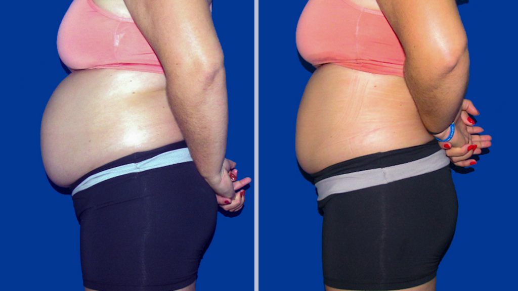 Resultado Emagrecimento e Gordura Localizada Abdomem