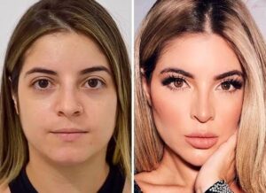 Antes e Depois Harmonização Facial Gkay