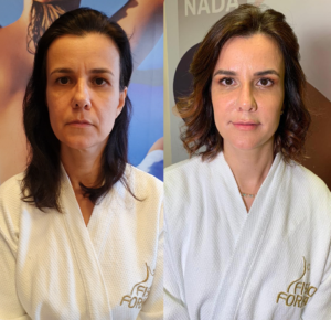Harmonização facial - antes e depois