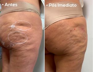 antes e depois gluteos