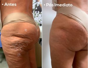 antes e depois gluteos
