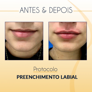 antes e depois preenchimento labial