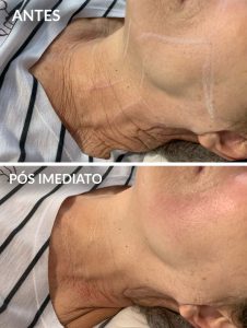 antes e depois ultraformer iii