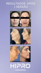 antes e depois hipro