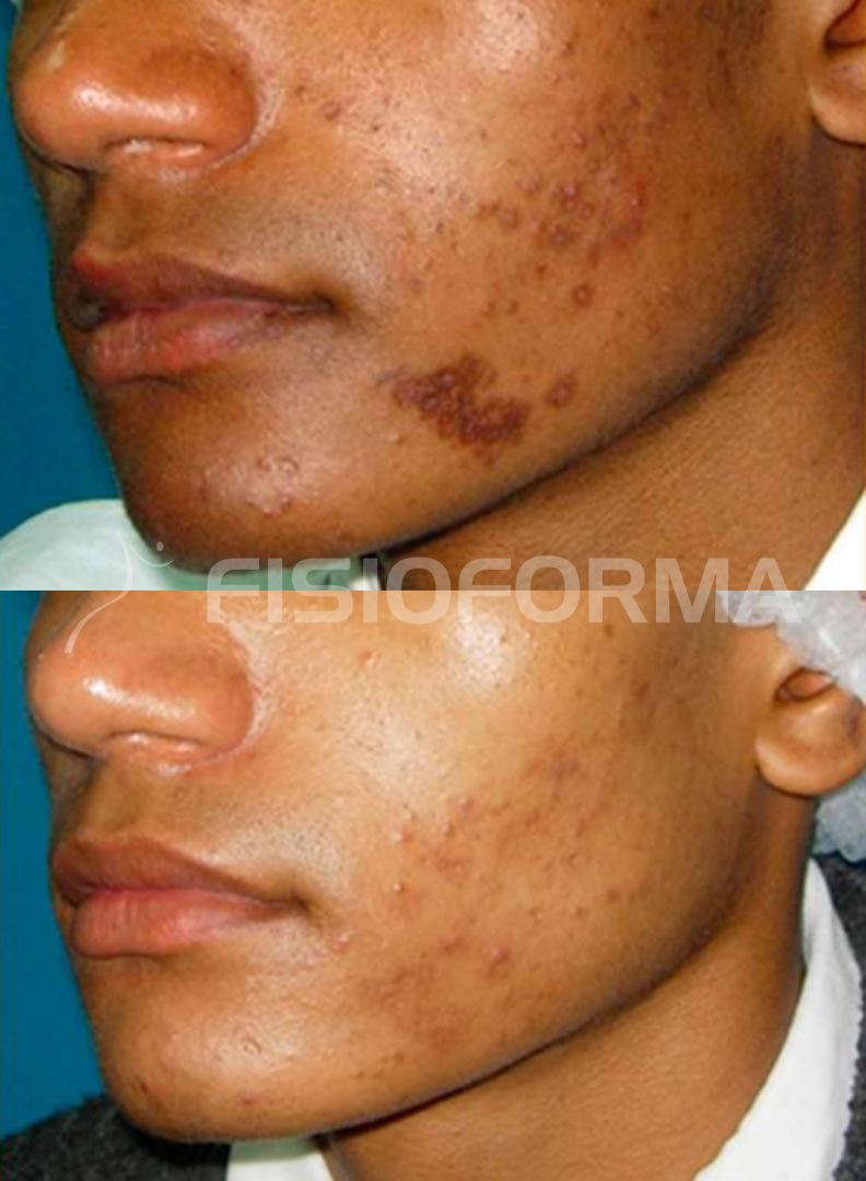 ACNE_01