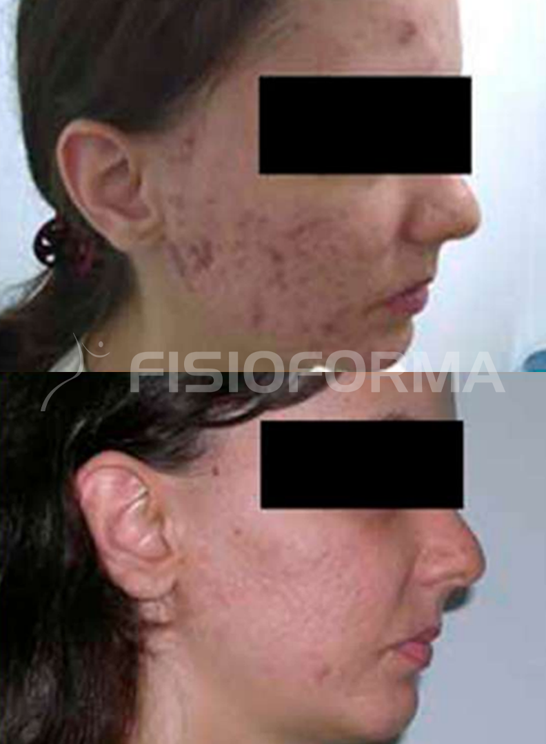 ACNE_02