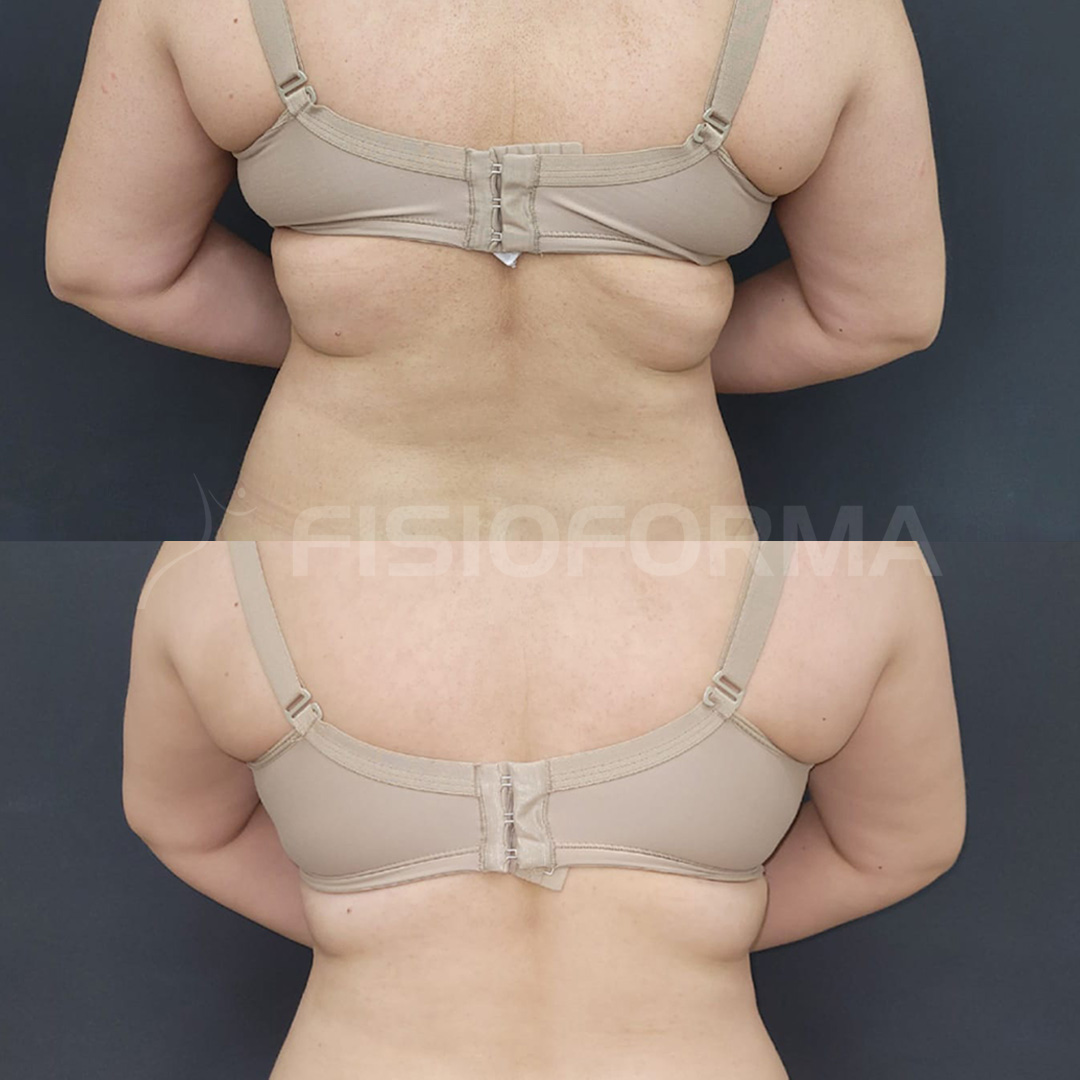 ANTES E DEPOIS_endolift costas