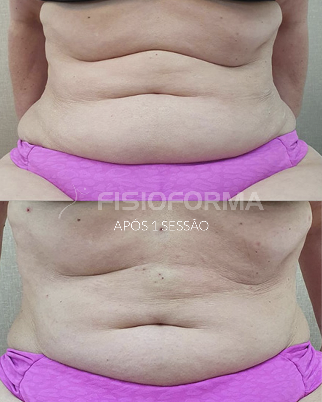 ENDOLIFT_Barriga