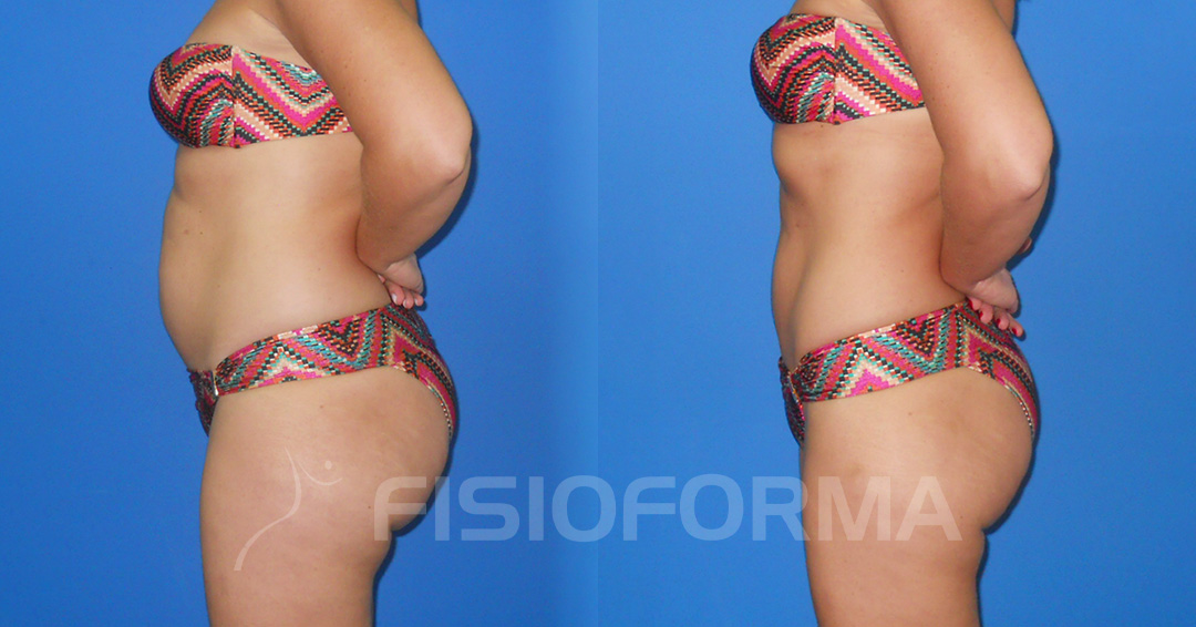 RESULTADO_corporal lipotech