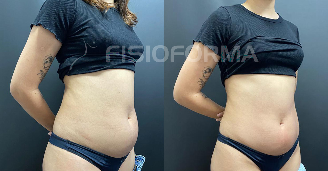 ANTES E DEPOIS_Alma prime gio