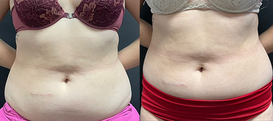 ANTES E DEPOIS_Alma prime1