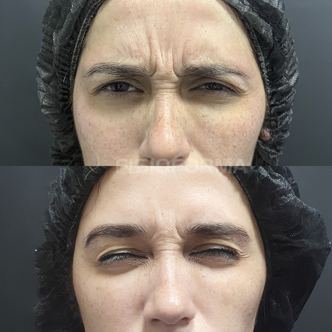 BOTOX_Antes e depois_maya