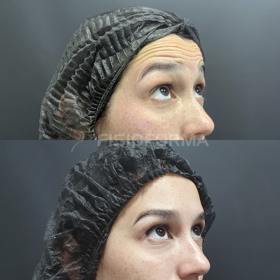 BOTOX_Antes e depois_maya 2