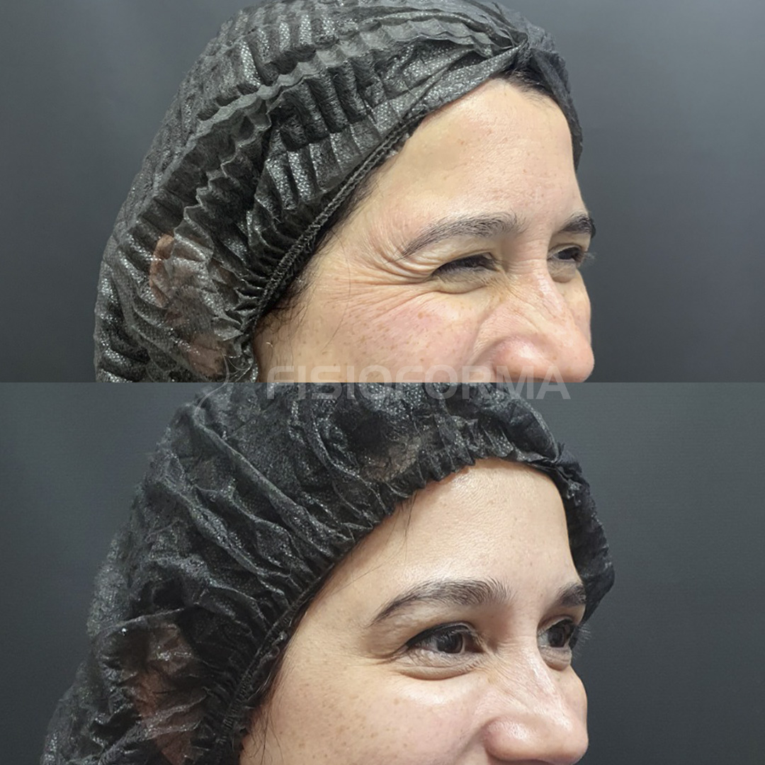 BOTOX_Antes e depois_maya 3