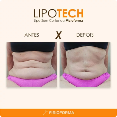 Lipo Tech 1