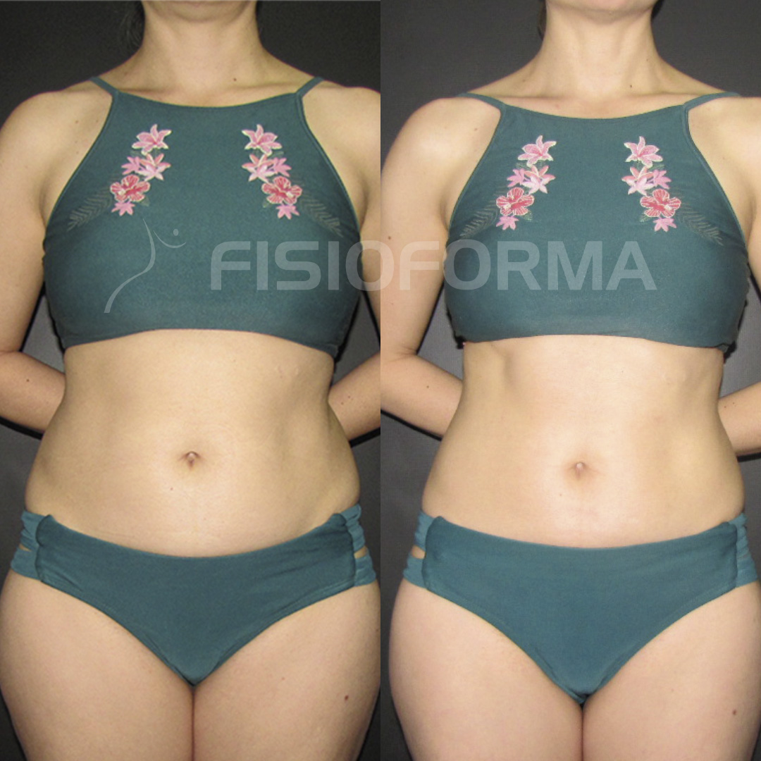 RESULTADO_seca gordura vivi