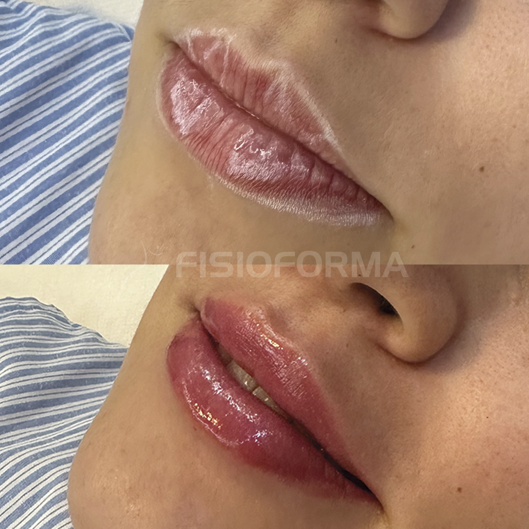 PREENCHIMENTO LABIAL_01