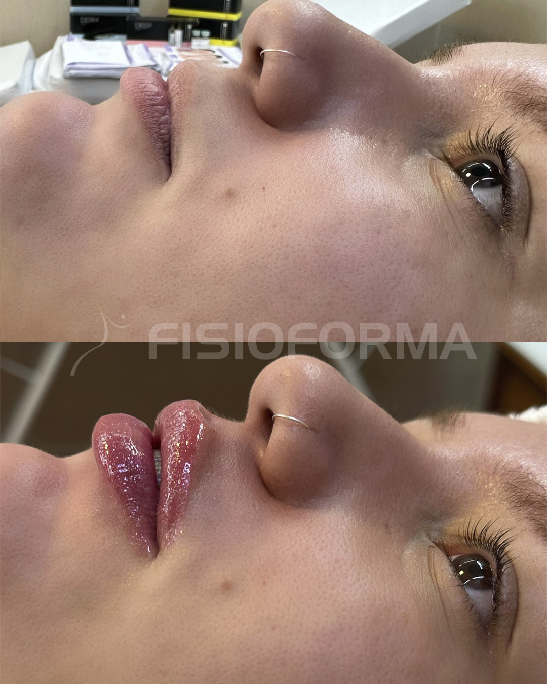 RESULTADO_preenchimento labial