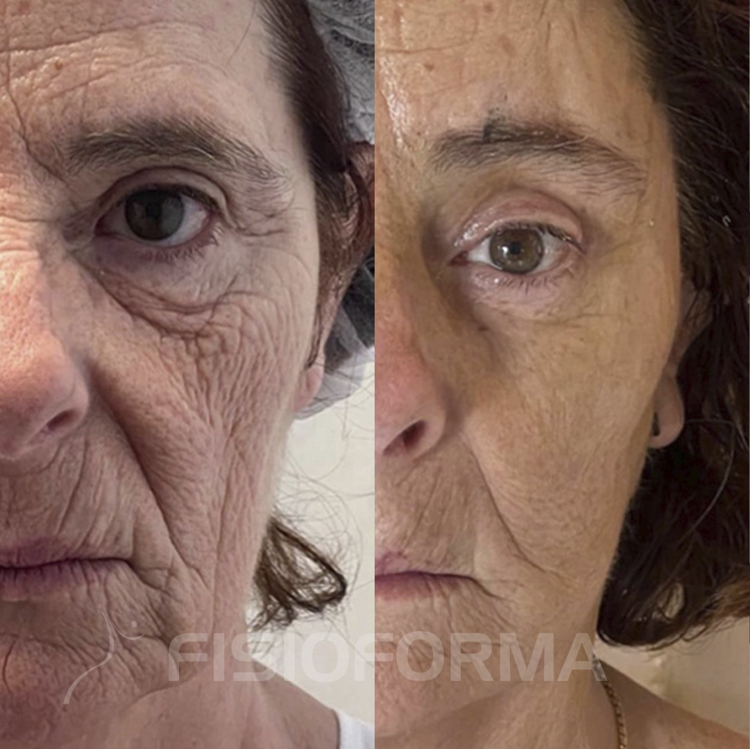RESULTADO_rejuvenescimento facial ENDOLIFT