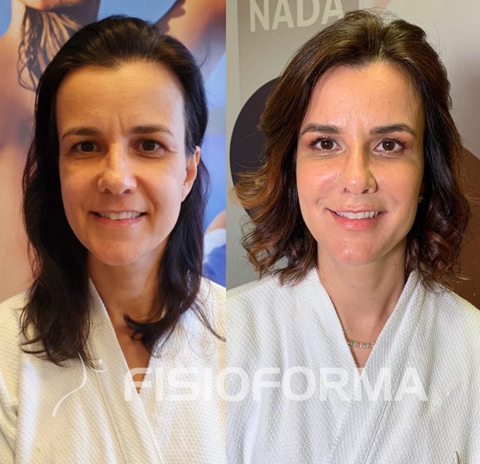 RESULTADO_rejuvenescimento facial